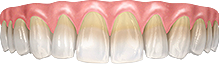 Проблема цвета эмали. «Тетрациклиновые зубы» 