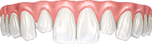 Разная длина зубов и выдвижение из зубного ряда
