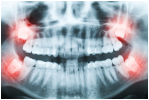 Рентген во время лечения зубов мудрости.png