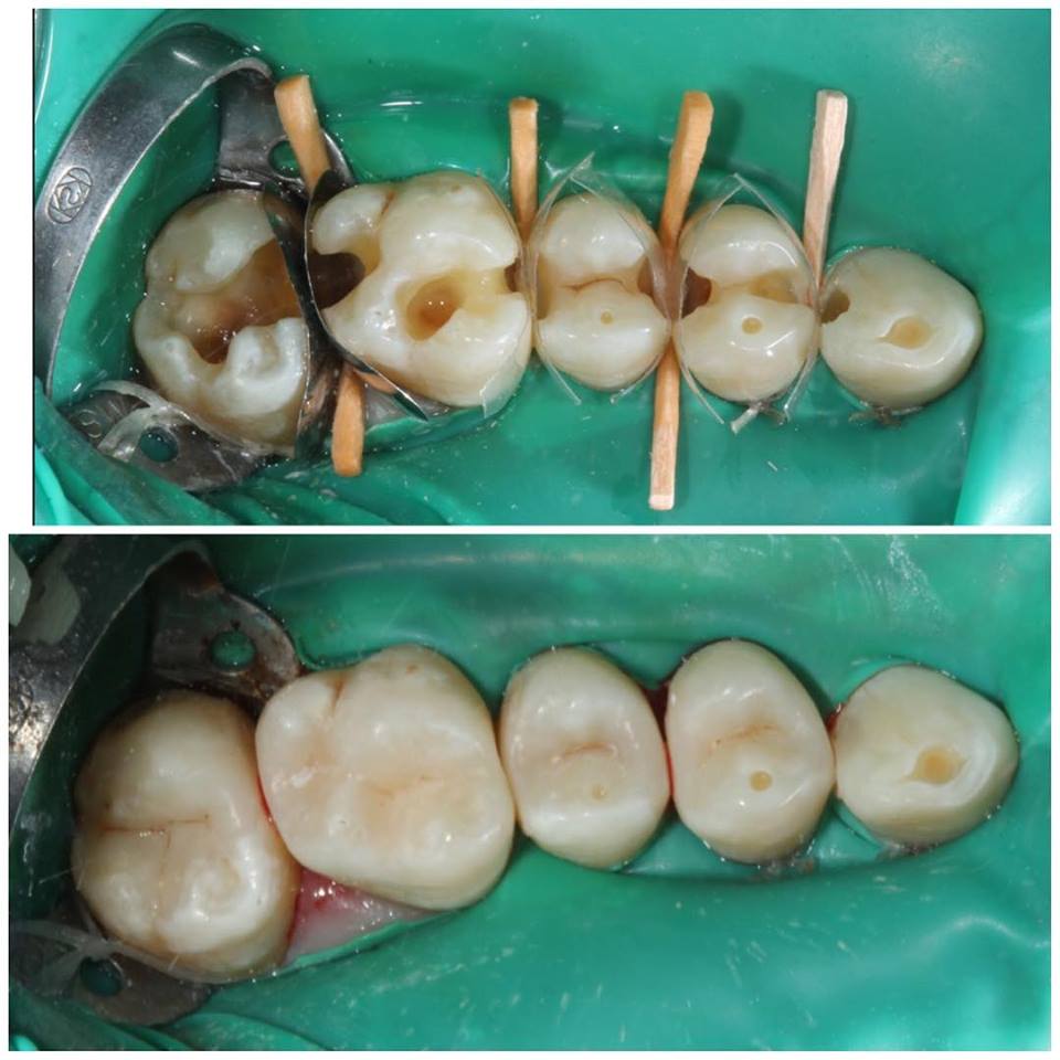 Лечение нескольких зубов в одном сегменте