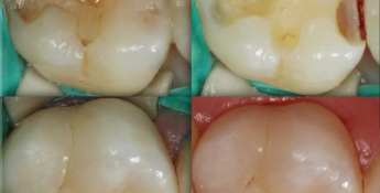 Композитные реставрации на зубы